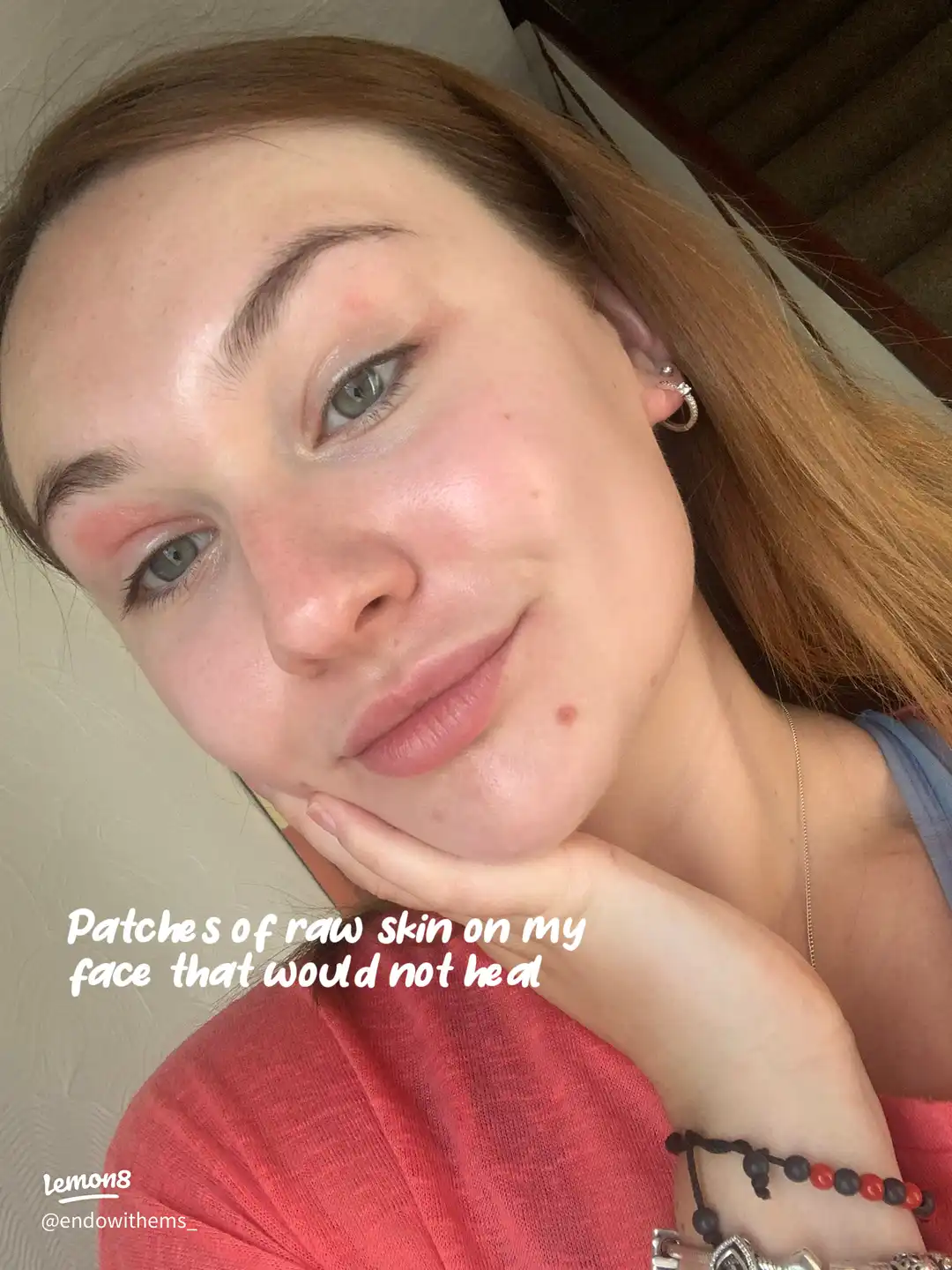 Symptoms of Autoimmune disease's images(2)